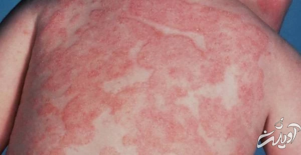 اثرات دیابت بر پوست عفونت قارچی